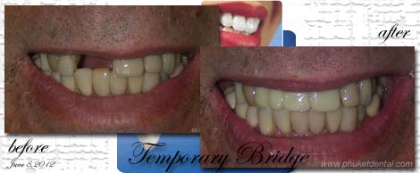 Temporary Crowns&Bridges at Phuket Dental Clinic,Thailand